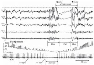 EEG در سنکوپ
